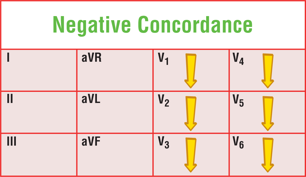 The illustration shows that during negative concordance in ventricular tachycardia, arrows point downward in leads V1 through V6.