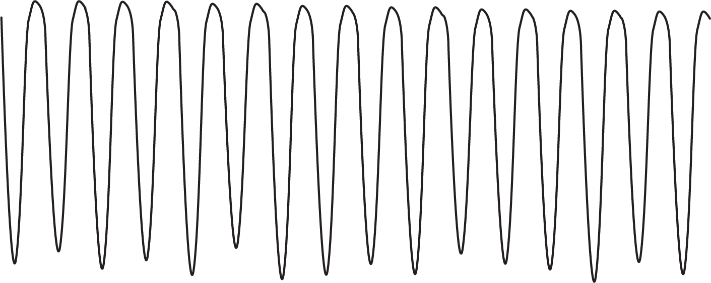 The ECG complex shows narrow peaks and dips of very high amplitude, occurring at high frequency.