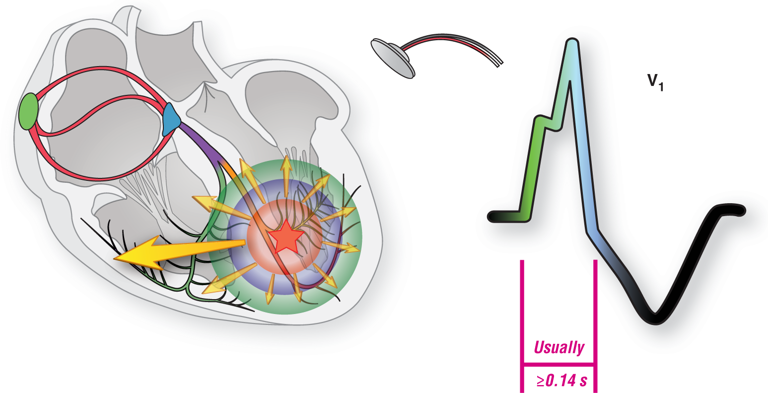 The illustration and the ECG complex show the features of an RBBB-like VTach.