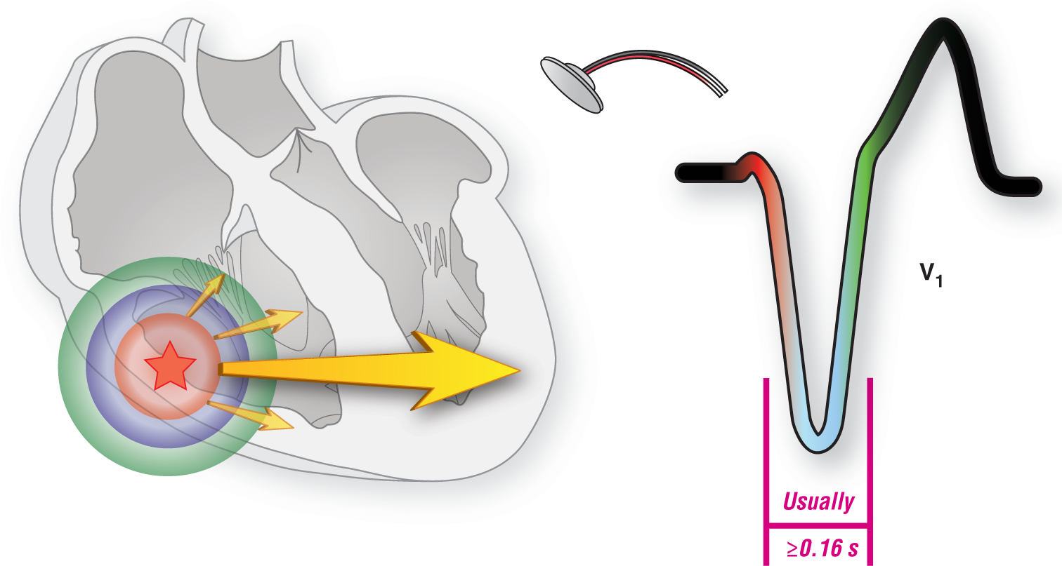 The illustration and an ECG complex show the features of an LBBB-like VTach.