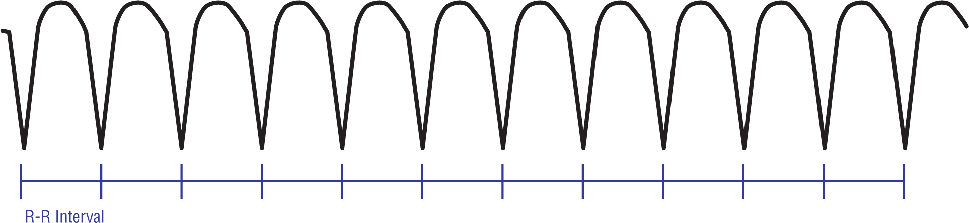 The ECG complex shows wide and curved peaks and sharp dips of high amplitude and high rate. The R-R intervals are constant.