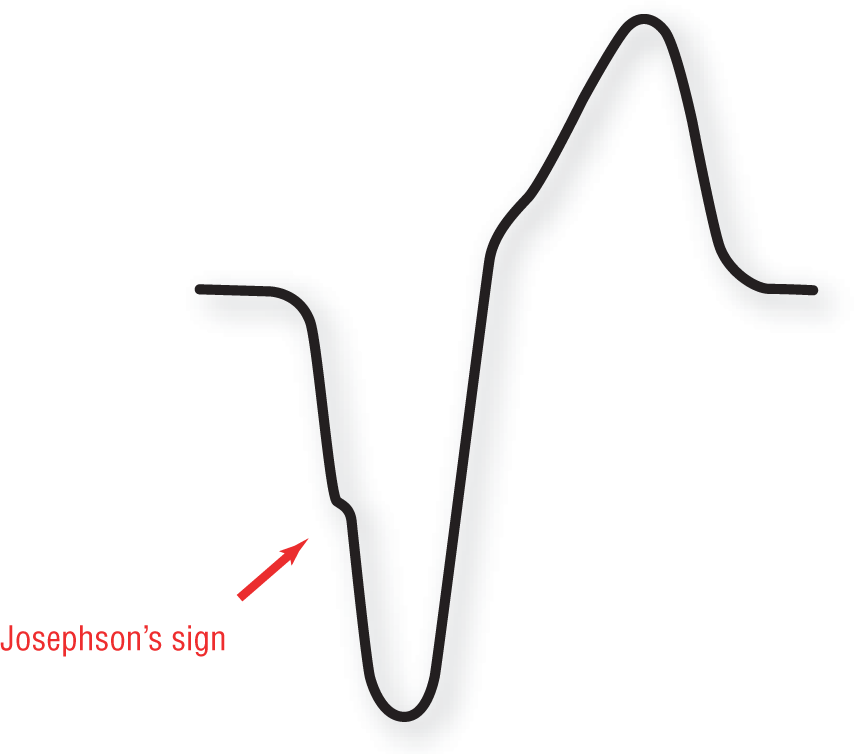 The illustration of an ECG complex shows that Josephson’s wave is the notch in the downstroke of the S wave.