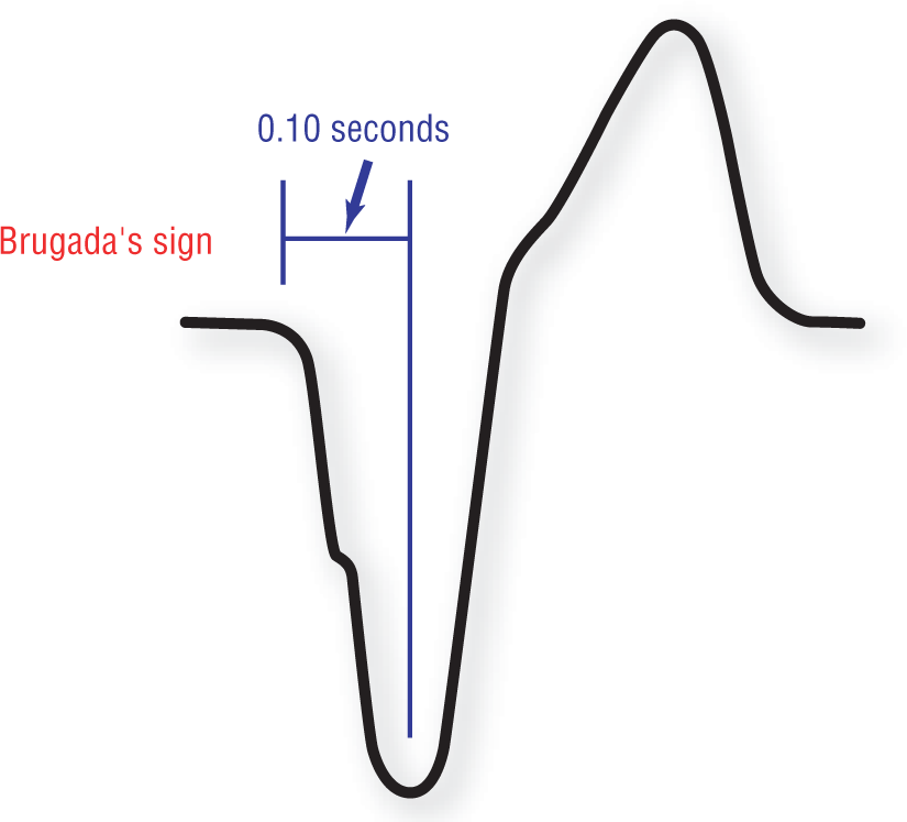 The illustration of an ECG complex shows that Brugada’s sign is the distance between the onset of the QRS complex and the bottom of the S wave. The distance is greater than or equal to 0.10 seconds.