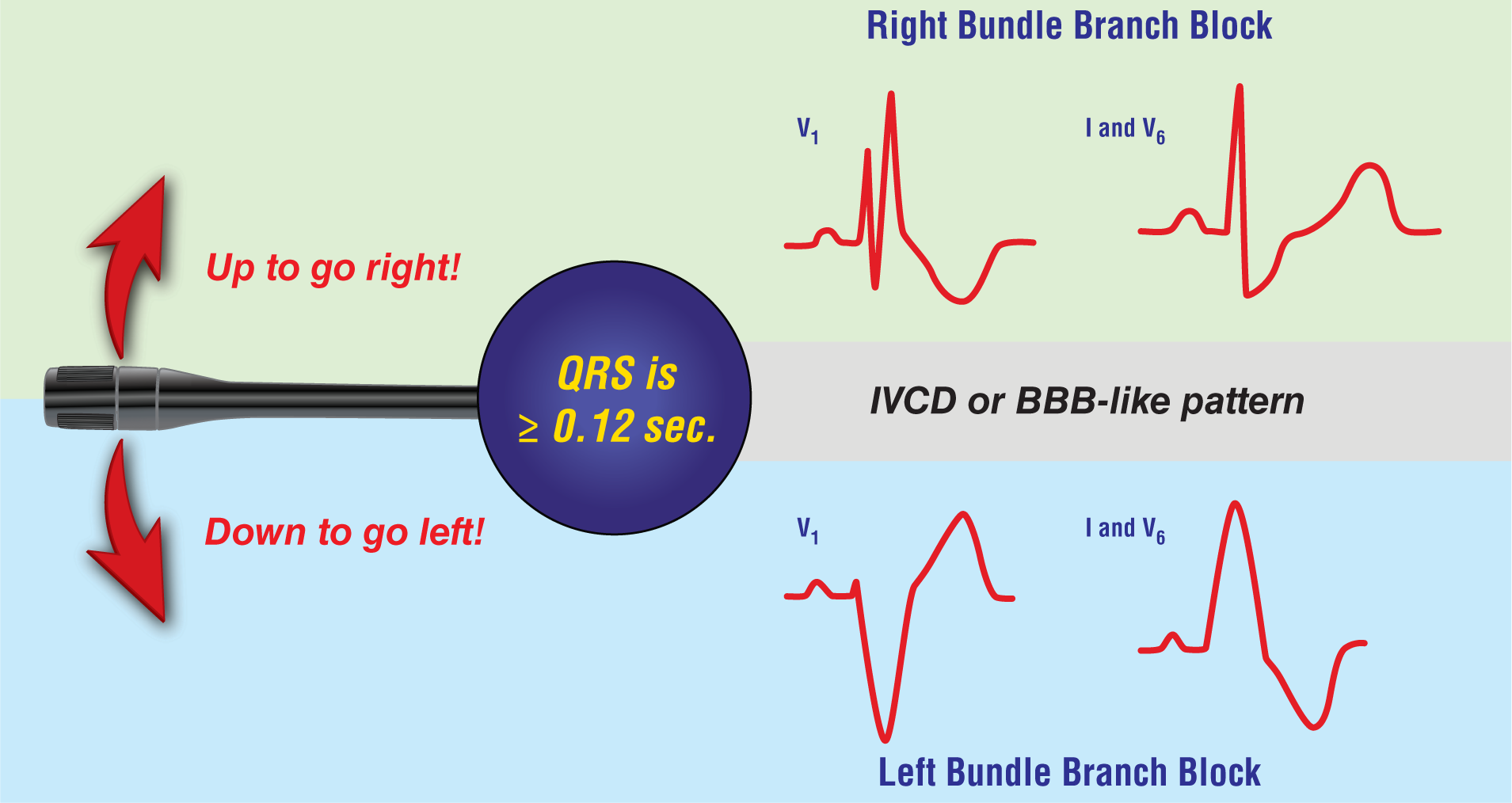 The illustration shows the IVCD and BBB-like pattern when the lever is moved up and down.