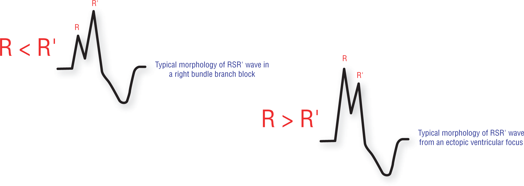 Two ECG complexes show the morphologies of RSR prime waves.