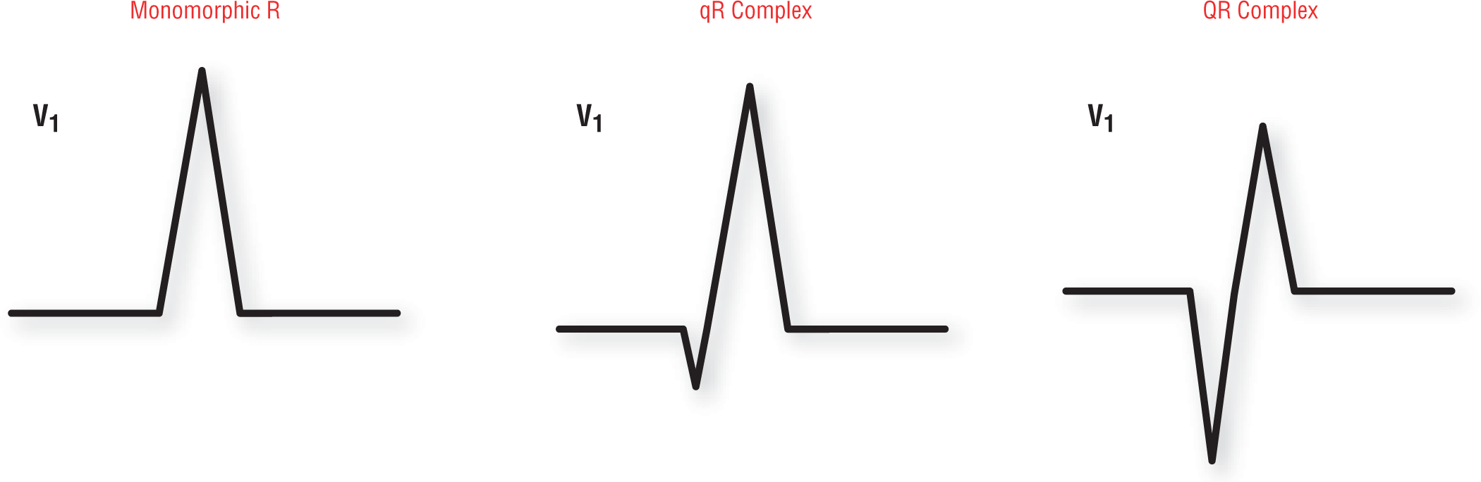 Three ECG complexes show morphologies of waves from lead V1 in a patient with wide-complex tachycardia.