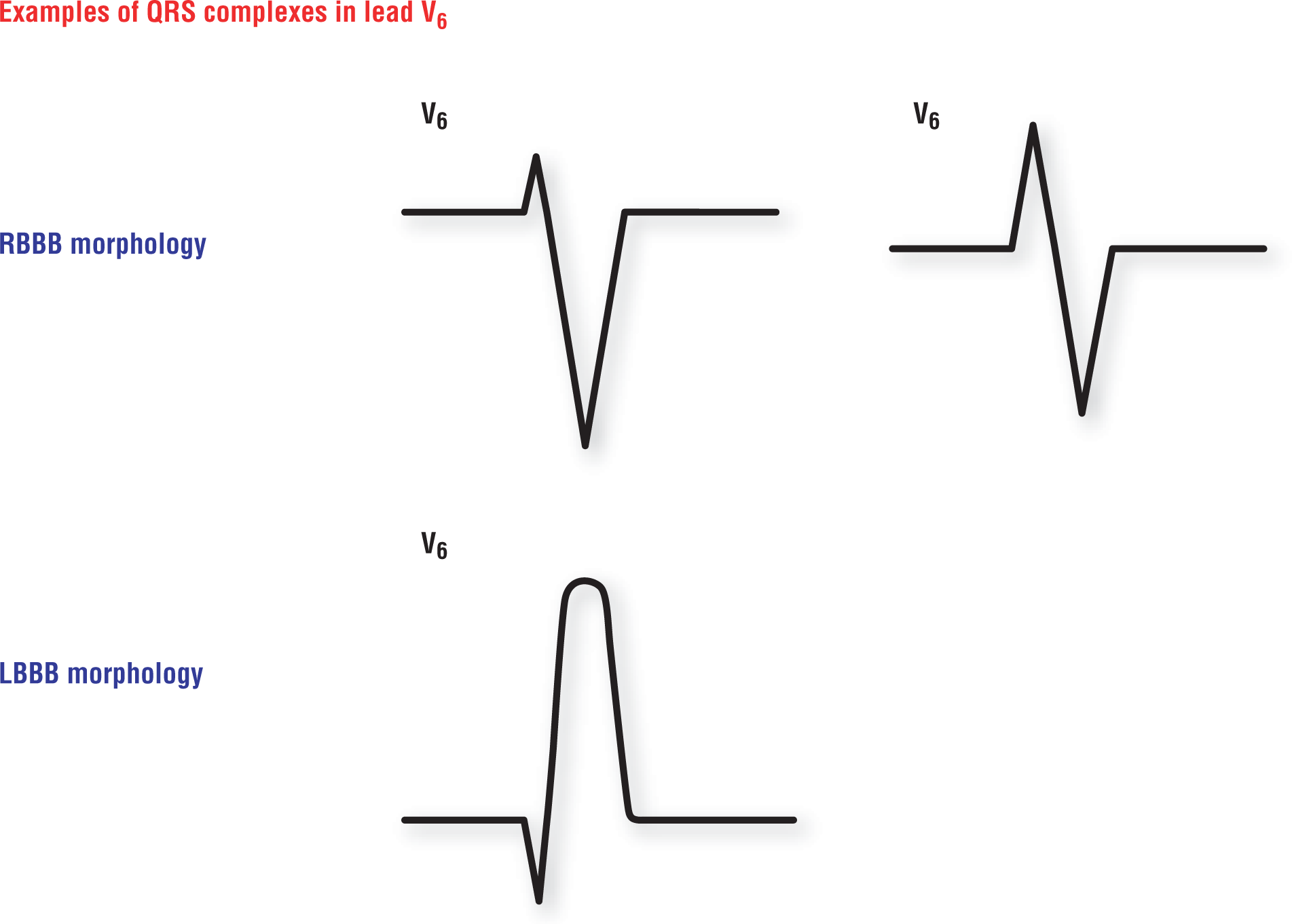 ECG complexes show RBBB and LBBB morphologies of QRS complexes in lead V6.