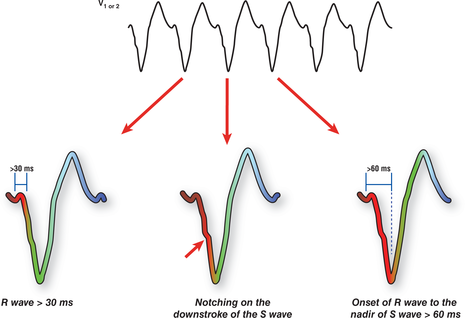 The ECG complex from leads V1 or V2 show the LBBB-like morphology in VTach.