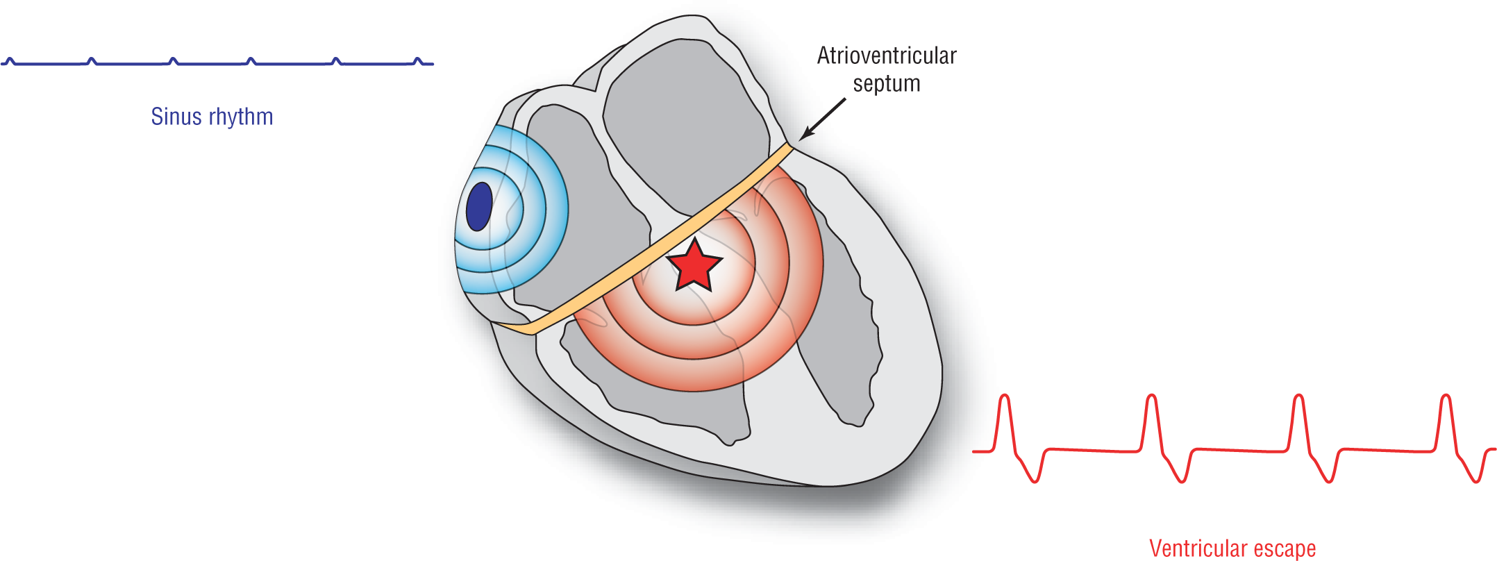 The illustration shows the pattern of waveforms when the atrioventricular septum completely separates the atria from the ventricles.