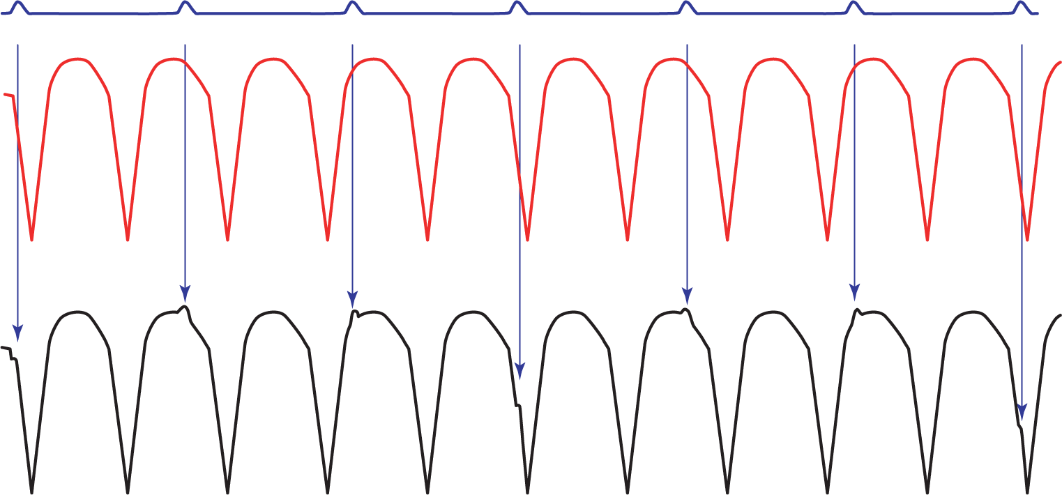 The illustration shows that when the complexes of sinus rhythm and VTach are mixed, there are notching and bumps throughout the VTach complex.