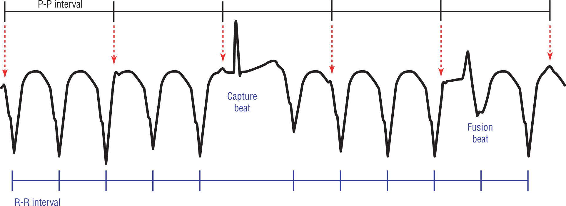 The ECG complex shows ventricular tachycardia, captured beat, and fusion beat.