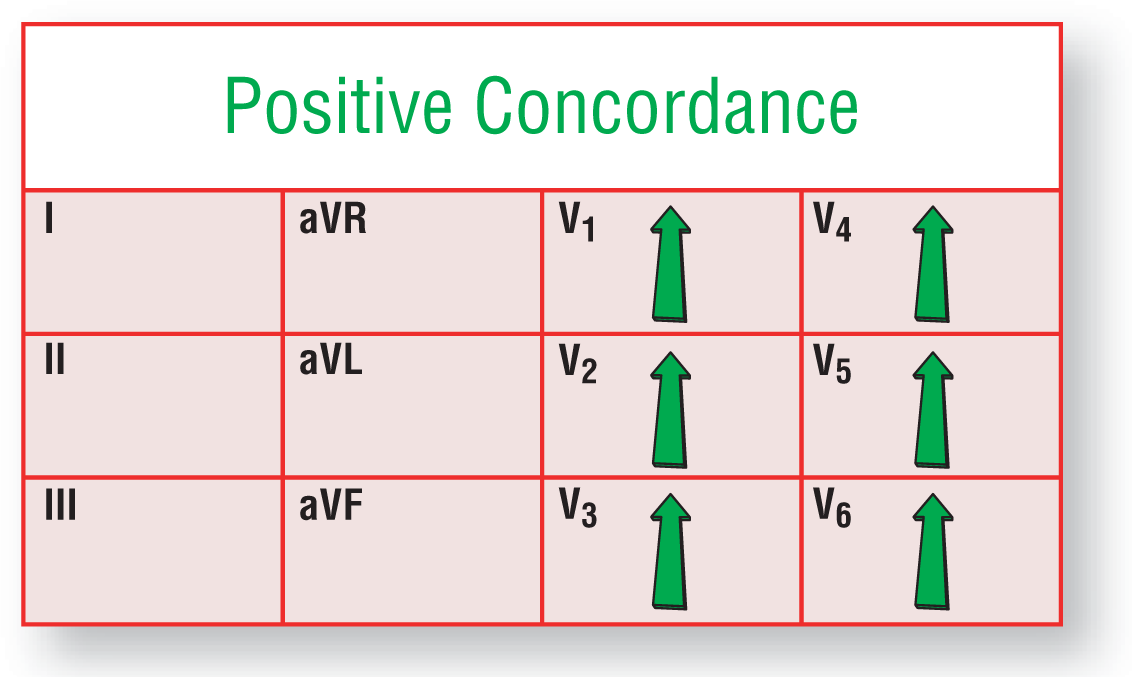 The illustration shows that during positive concordance in ventricular tachycardia, arrows point upward in leads V1 through V6.