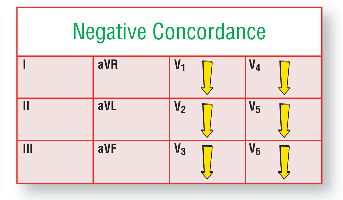 The illustration shows that during negative concordance in ventricular tachycardia, arrows point downward in leads V1 through V6.