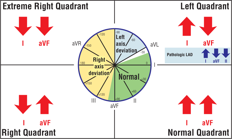 The illustration shows the polarity of QRS complexes in leads 1 and aVF in four quadrants.