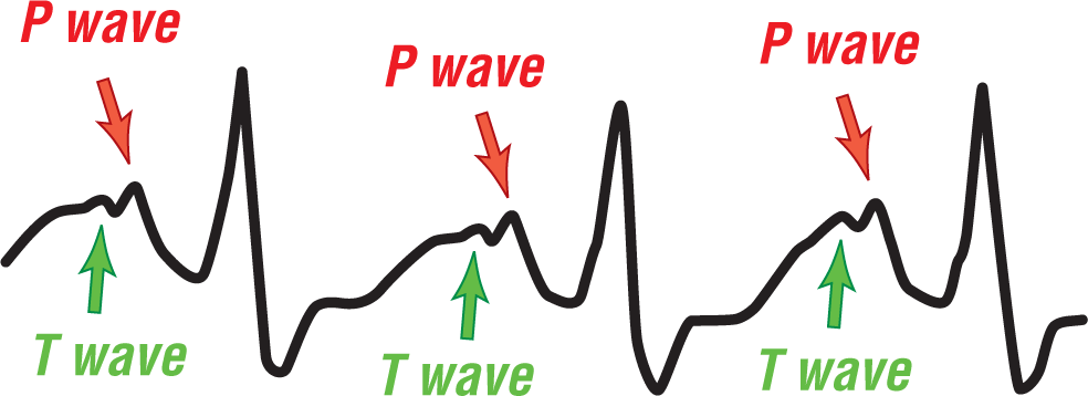 The ECG complex shows that complexes in lead 2 consist of a small peak of the P wave, a sharp peak of the QRS complex, a dip of the S wave, and a small peak of the T wave immediately before the P wave.