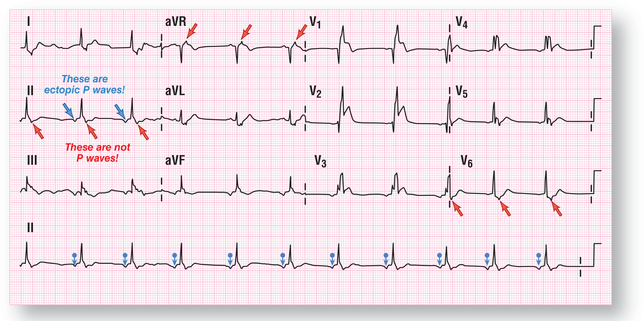 The rhythm strip shows ECG 1 for case 5.