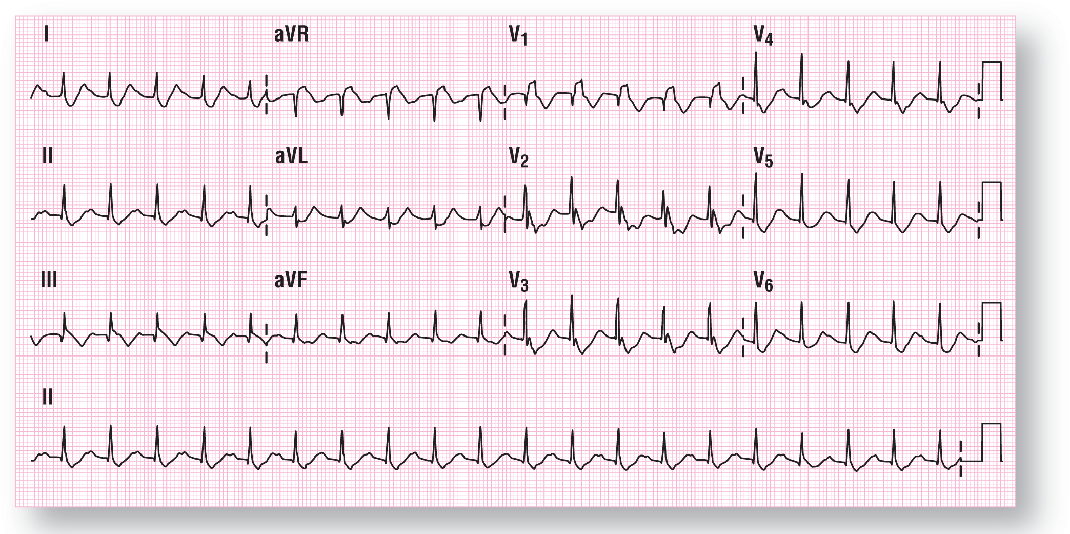 The rhythm strip shows ECG 2 for case 5.