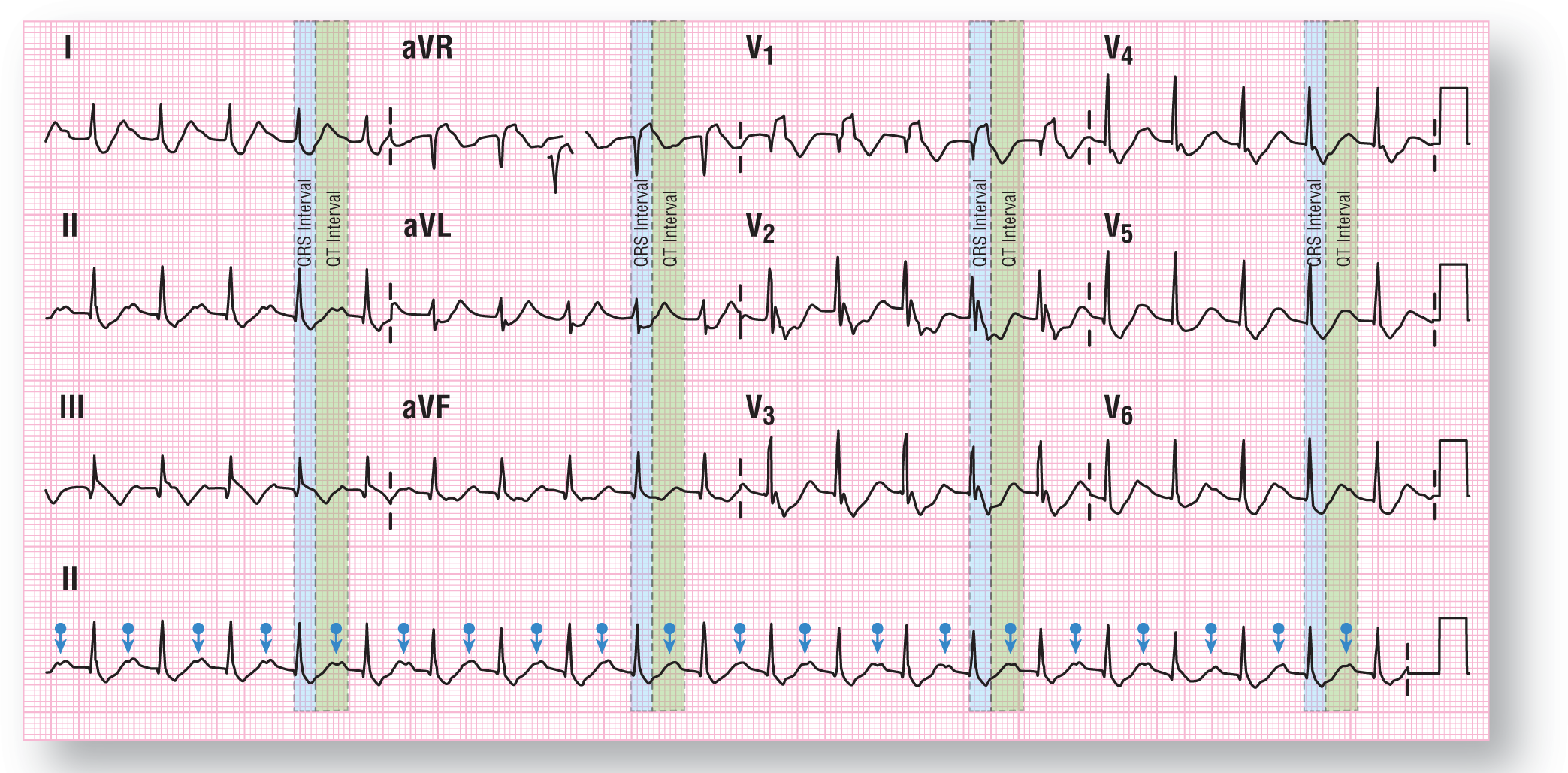 A rhythm strip shows ECG 2 for case 5.