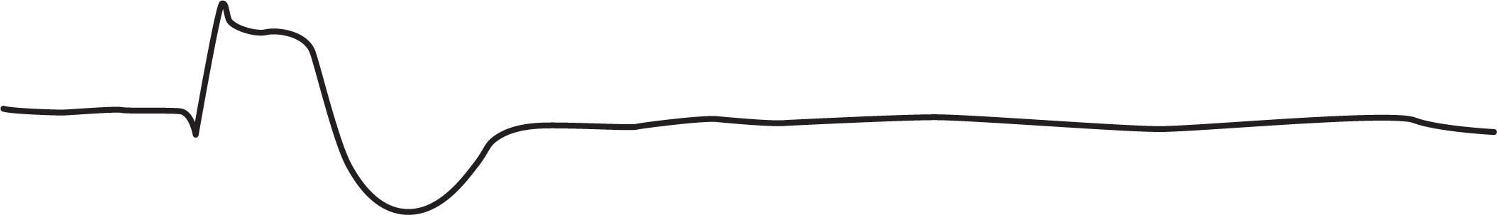 The ECG complex shows a broad peak with a small hump at the end of the upstroke, a wide and curved dip, and a straight line with wide and mild fluctuations.