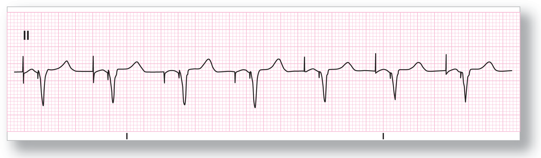 The rhythm strip from lead 2 shows a narrow dip and a wide and curved peak. A downward spike is before the beginning of the dip. In some complexes, an upward spike occurs before the downward one.