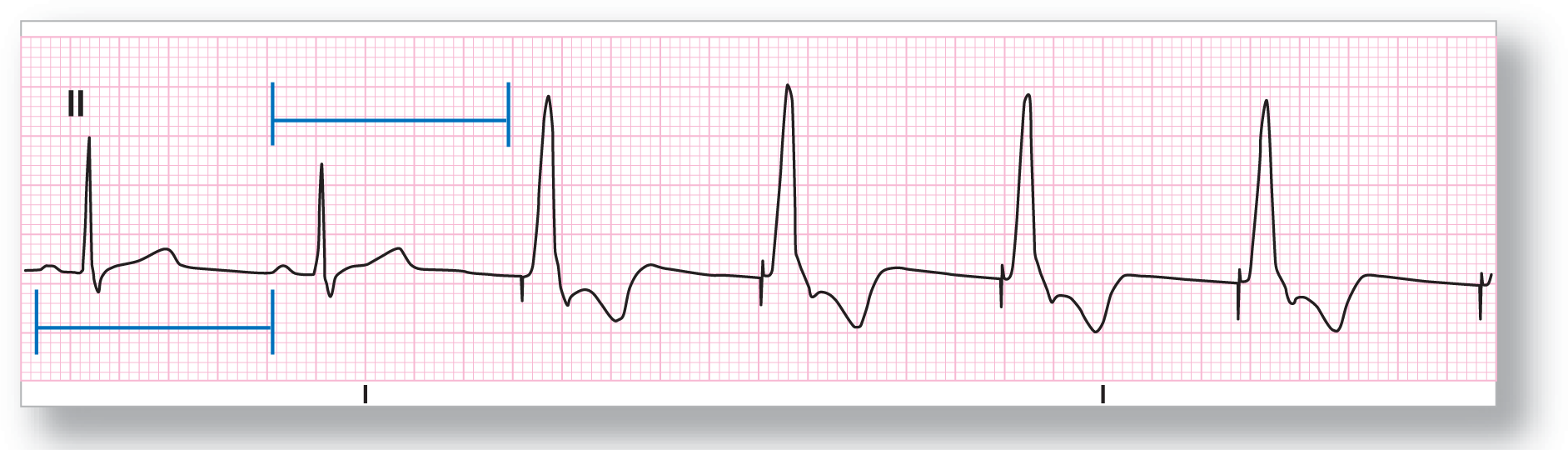 The rhythm strip from lead 2 shows an NSR leading to complexes with tall and narrow peaks and a curved dip. A spike occurs just before the peak.