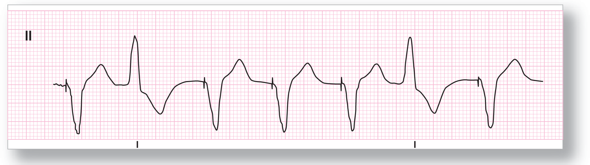 The rhythm strip from lead 2 shows a dip and a wide peak, with pacemaker spikes occurring before the dip. PVC, consisting of a peak and a wide dip, occurs every fourth complex.