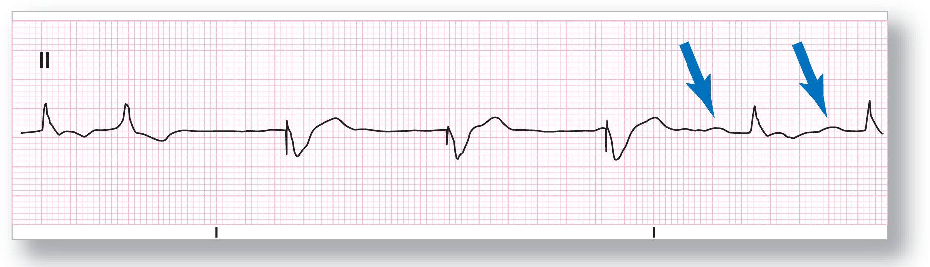 The rhythm strip from lead 2 shows NSR with a flat peak of the P wave and a small peak of the QRS complex in the first, second, sixth, and seventh complexes. The other complexes consist of a spike, a wide and sharp dip, and a broad peak.