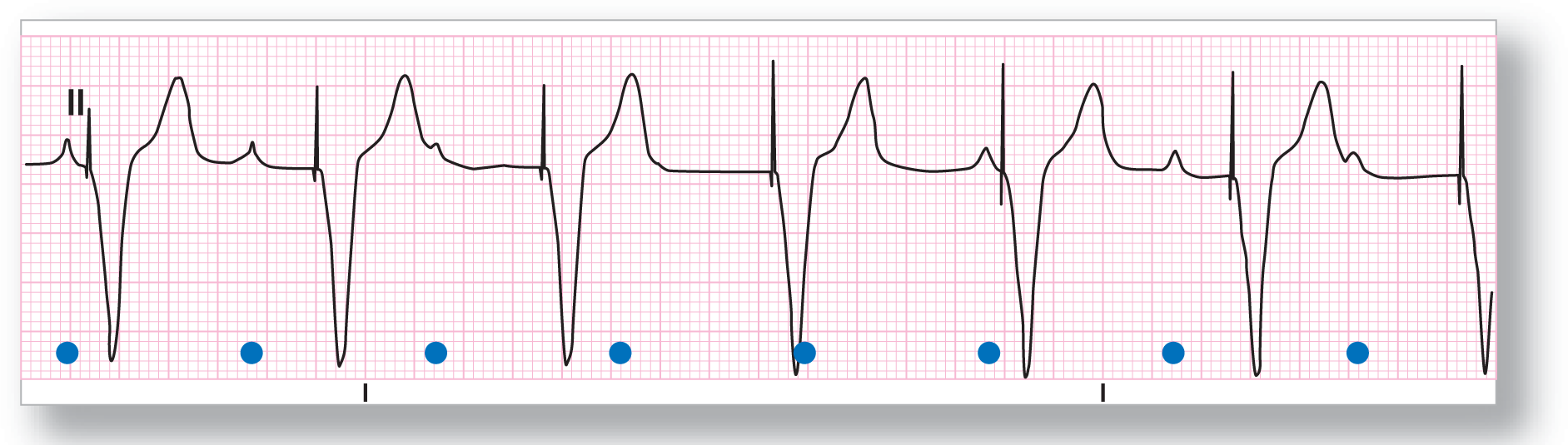 The rhythm strip from lead 2 shows a spike; a narrow, deep, and sharp dip; and a wide peak. P waves are buried in the complexes.