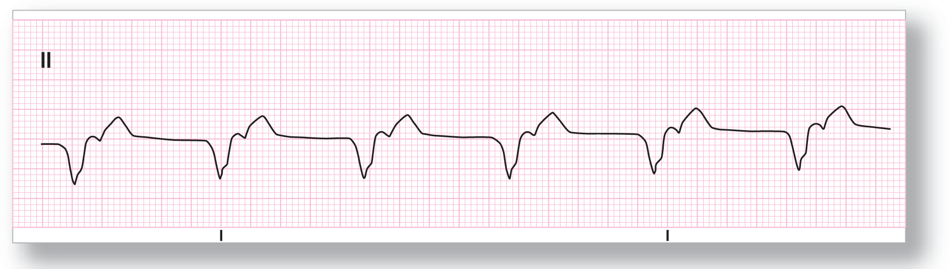 The rhythm strip from lead 2 shows a wide dip with a notching at the beginning of the upstroke, a curved peak, and a taller and wide peak.