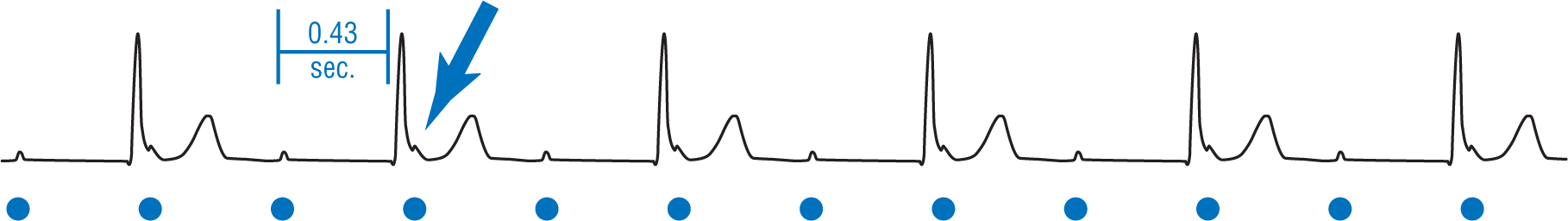 The ECG complex shows a sharp and narrow peak of the QRS complex and a wide and curved peak of the T wave. P waves occur as notching in the downstroke of QRS complex and between two complexes. The PR interval is 0.43 seconds.