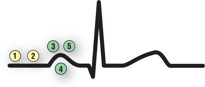 In a normal ECG complex, the beginning of the complex is labeled 1 and 2, and the P wave is labeled 3, 4, and 5.