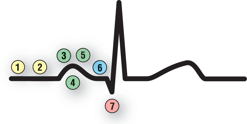 In a normal ECG complex, the beginning of the complex is labeled 1 and 2; the P wave is labeled 3, 4, and 5; the PR interval is labeled 6; and the Q wave is labeled 7.