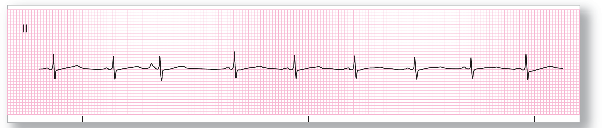 A rhythm strip.