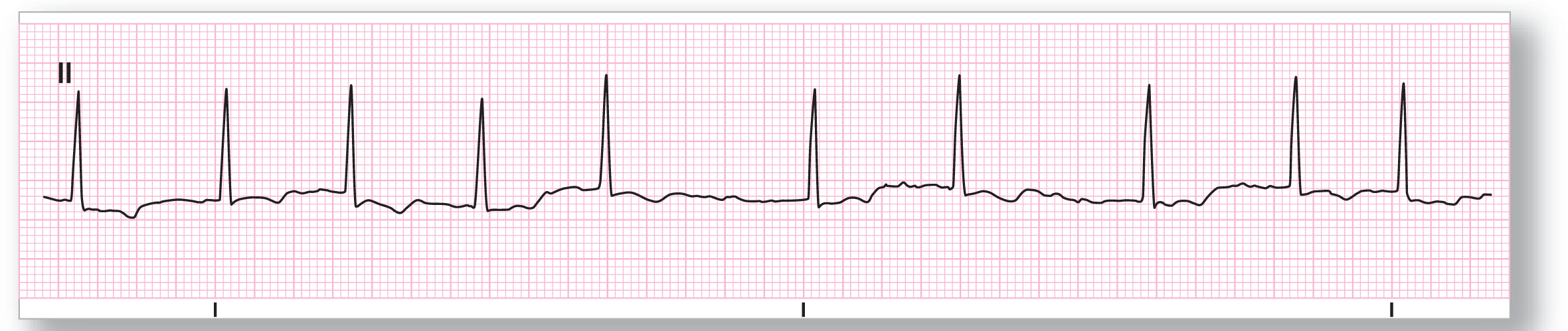 A rhythm strip.