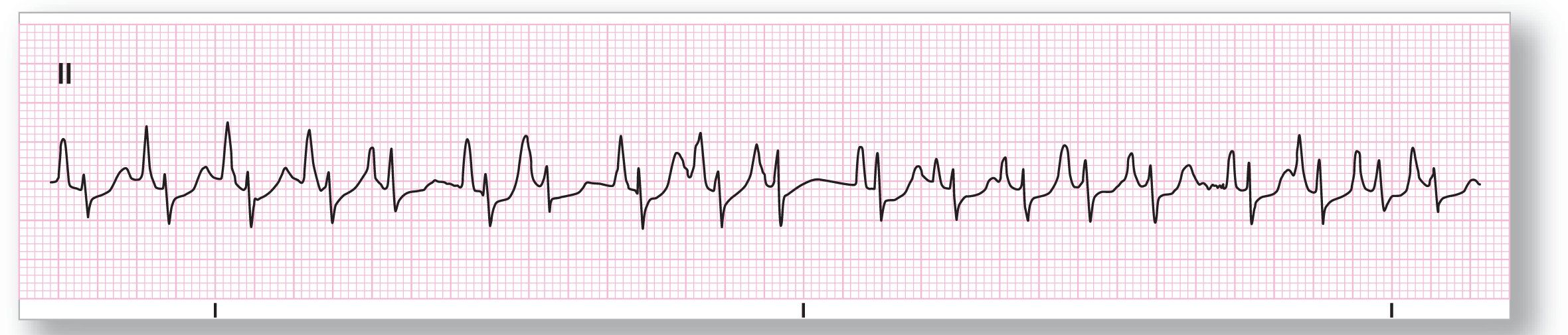 A rhythm strip.