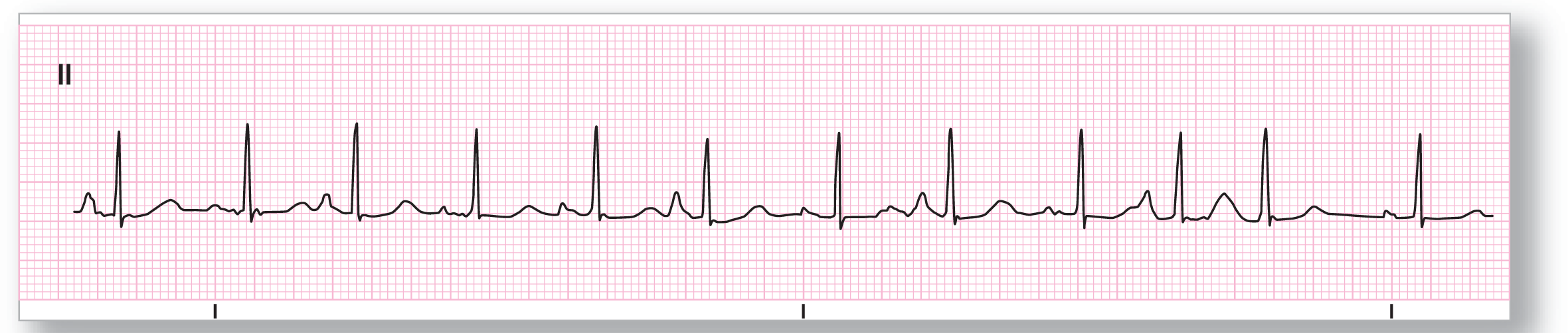 A rhythm strip.