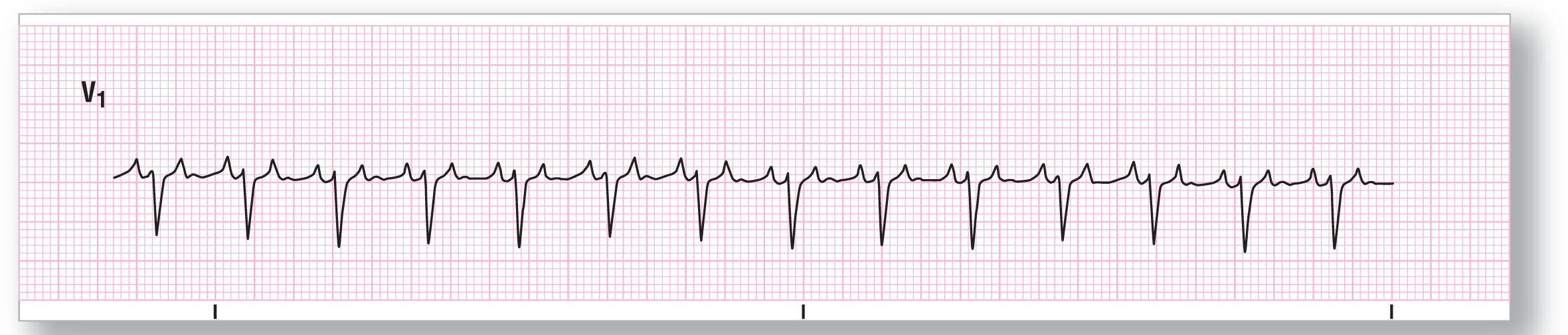 A rhythm strip.