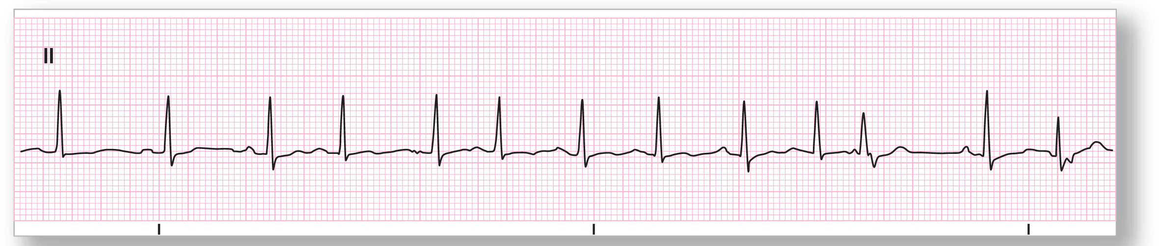 A rhythm strip.