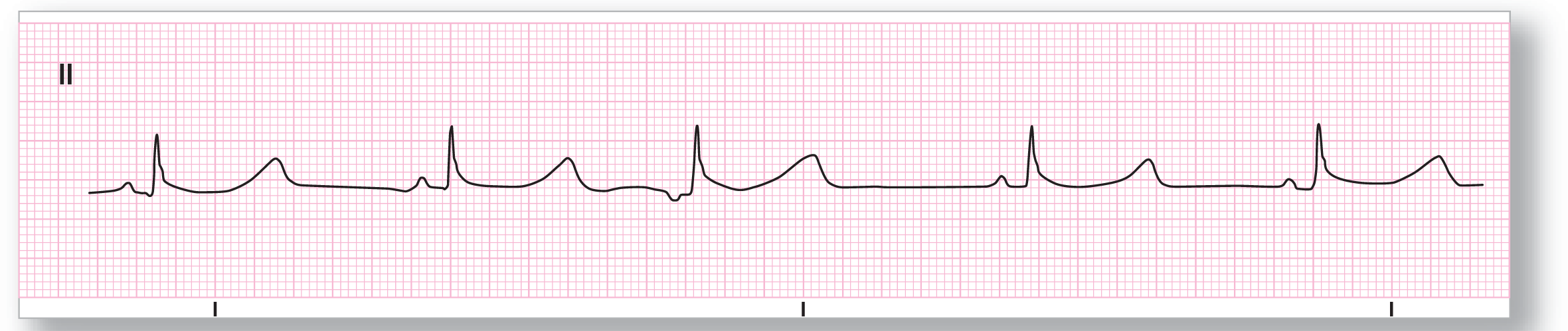 A rhythm strip.