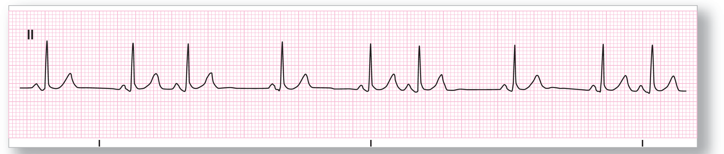 A rhythm strip.