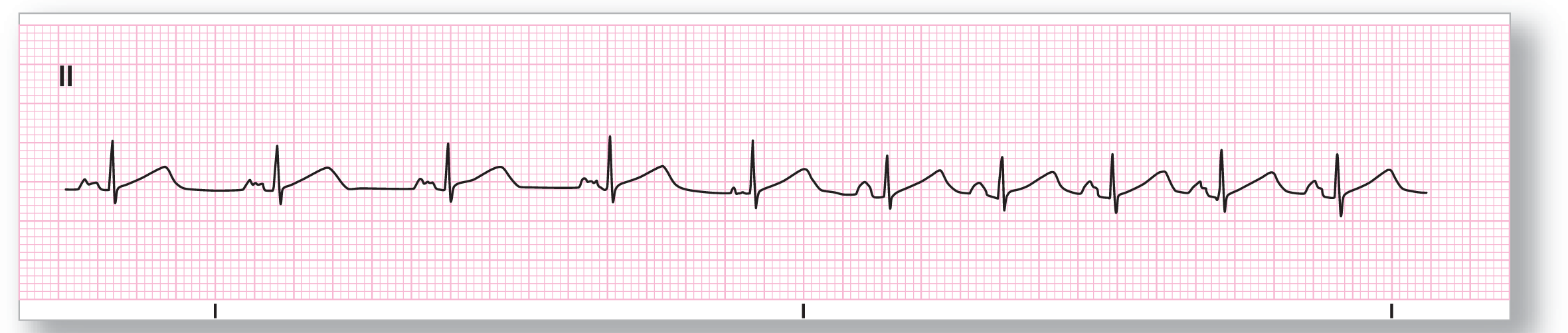 A rhythm strip.