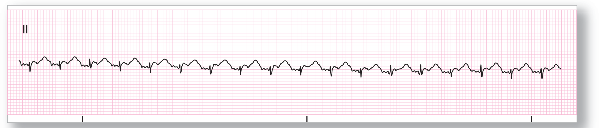 A rhythm strip.