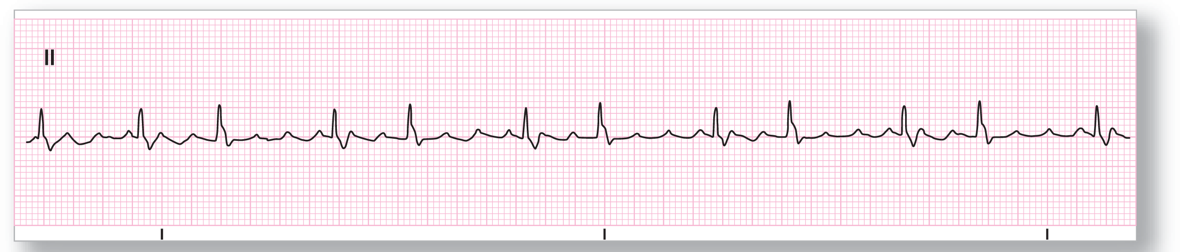 A rhythm strip.