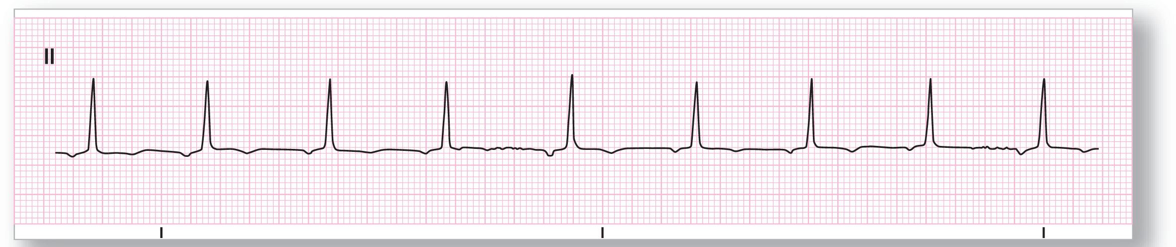 A rhythm strip.