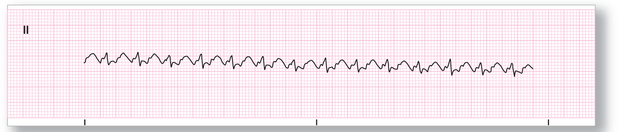 A rhythm strip.