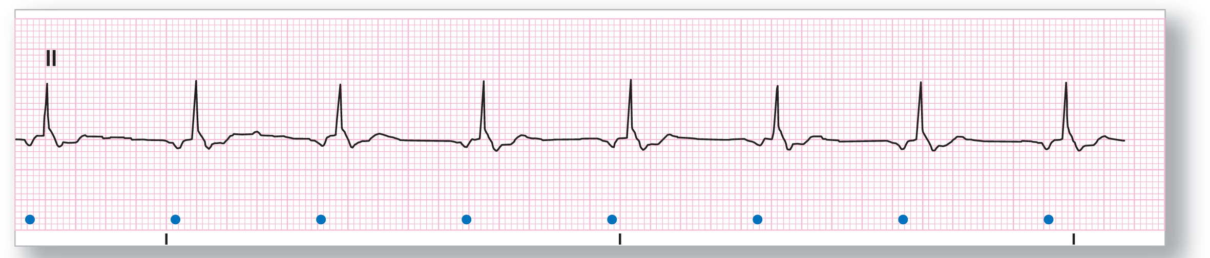 A rhythm strip from lead 2 shows an inverted and subtle P wave, a sharp and narrow peak of the QRS complex, a plateau of the ST segment, and a wide and curved peak of the T wave. The P waves are marked with dots.