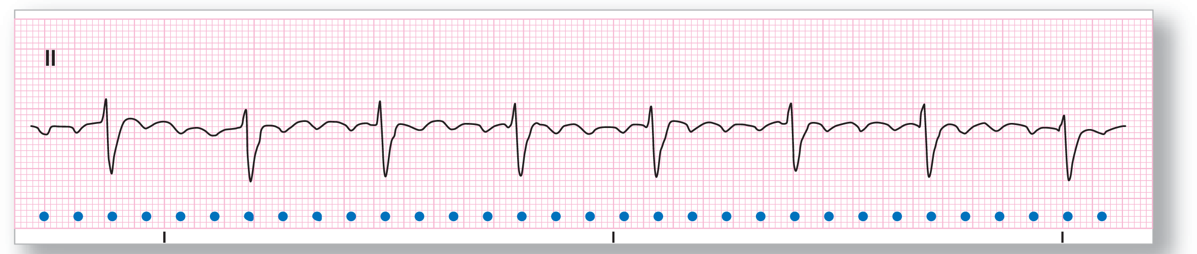 A rhythm strip from lead 2 shows wide and sharp dips of the QRS complexes between wide and flat peaks of the F waves, marked with dots.