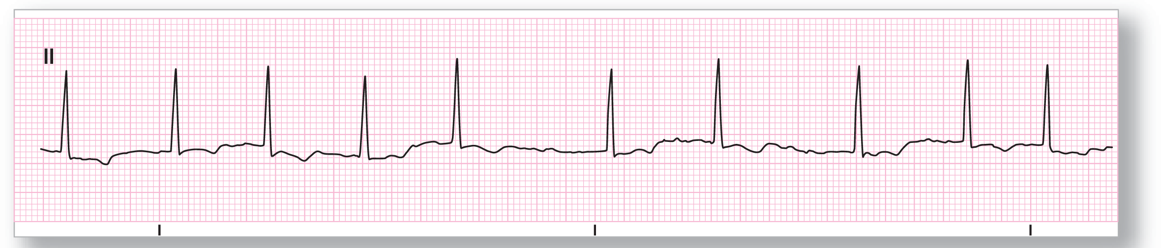 A rhythm strip from lead 2 shows a wandering baseline with sharp peaks of the QRS complexes between flat regions of fluctuations.