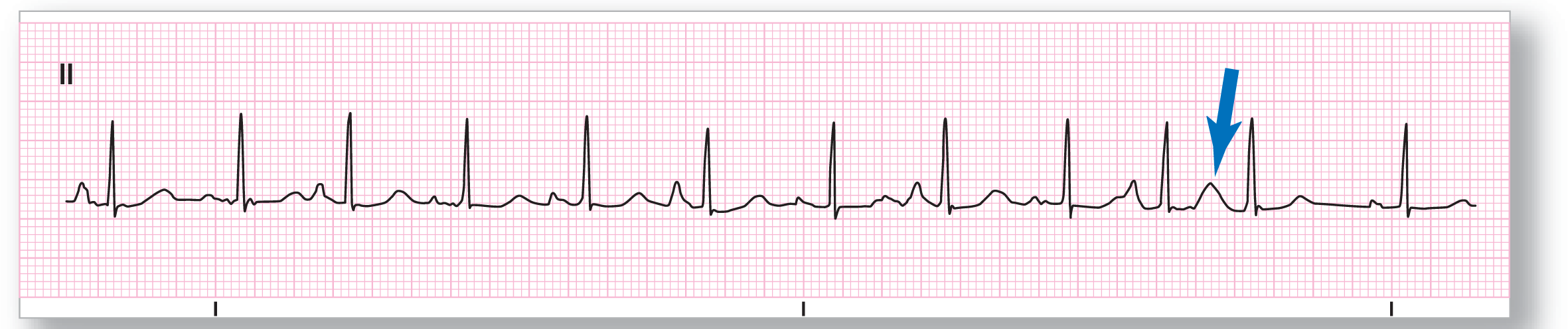 A rhythm strip from lead 2 illustrates multifocal atrial tachycardia.