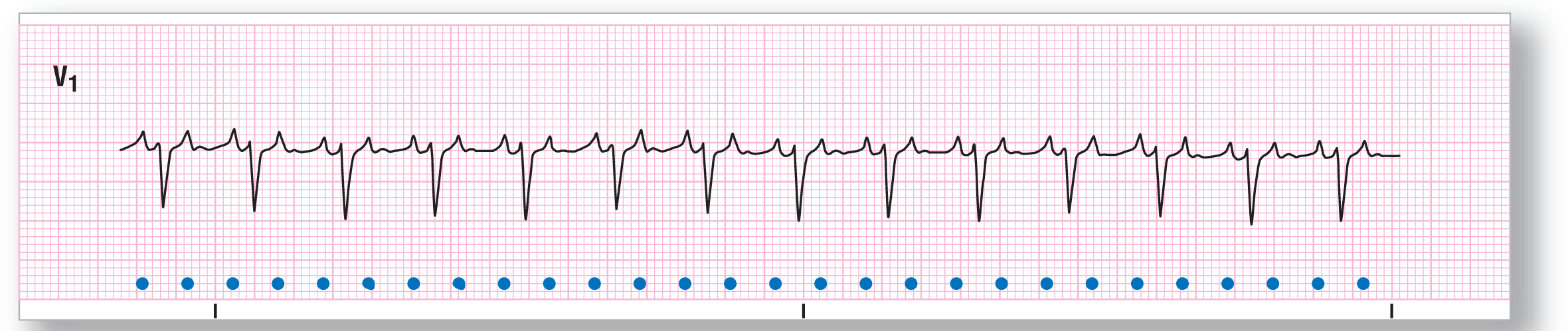 A rhythm strip from lead V1 shows a sharp dip of the QRS complex with small and sharp peaks of the P wave and buried P wave on its either sides.